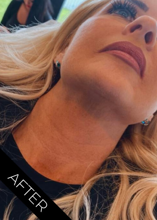After PROHILO to reduce neck wrinkles