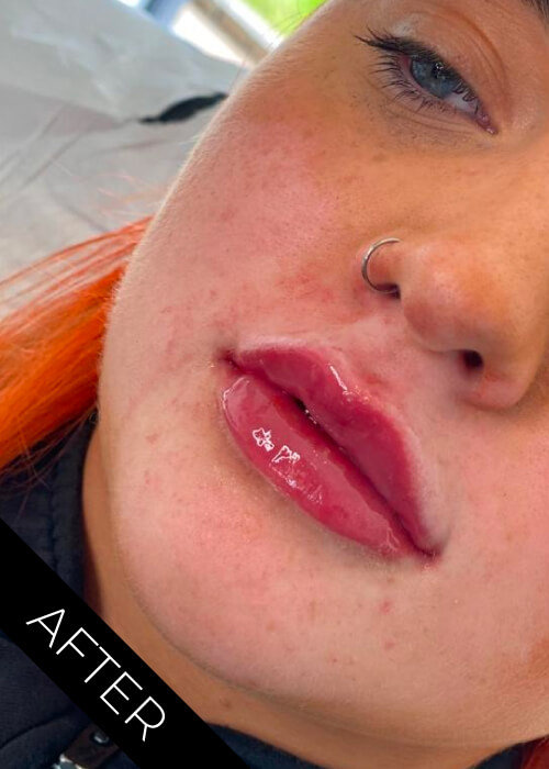 After Lips