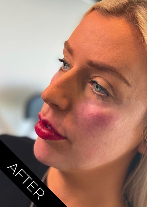 After Facial Contour treatments Belfast
