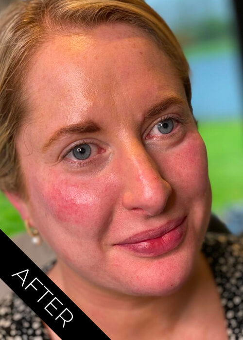 Face Contour after