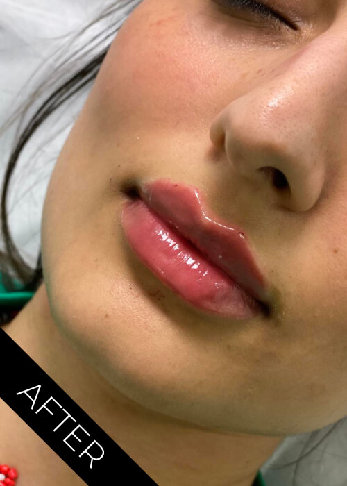 After Lips