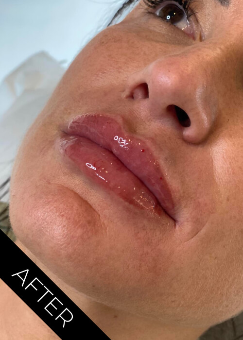 After Lips Fillers Ballyclare