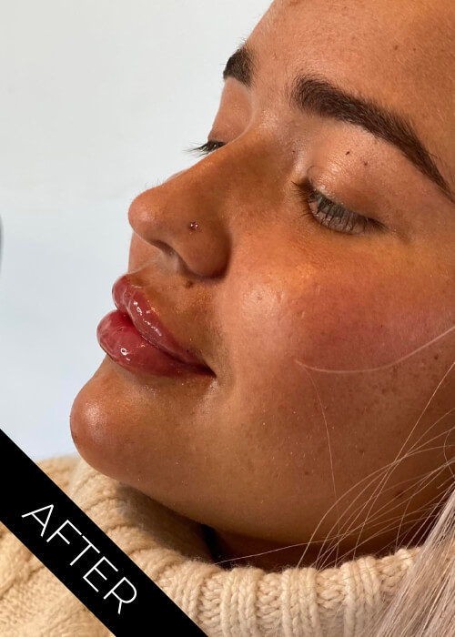 After facial contouring treatment