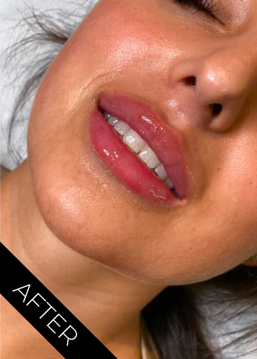 After 1.1ml Lip Filler