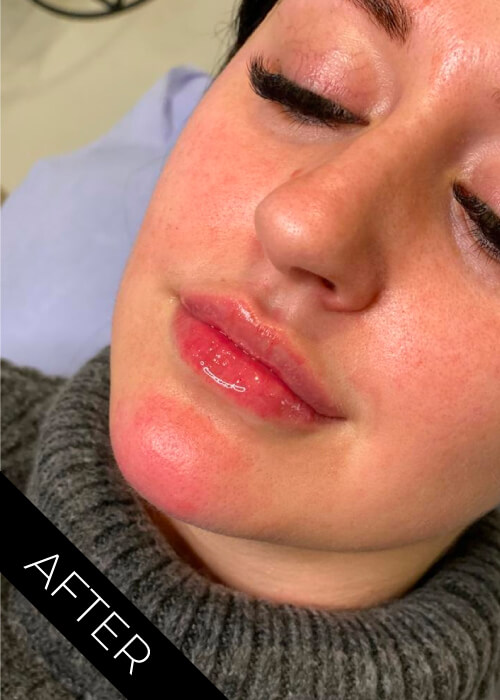 Lip filler after in Northern Ireland