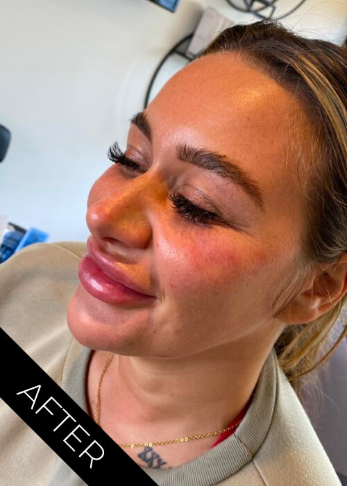 After Face Contouring