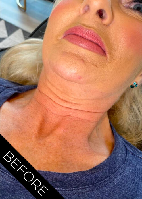Before PROHILO to reduce neck wrinkles