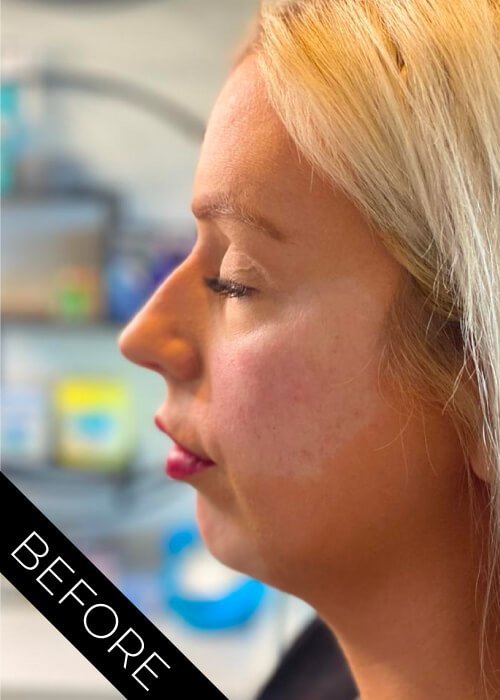 Before Facial Contour treatments Belfast