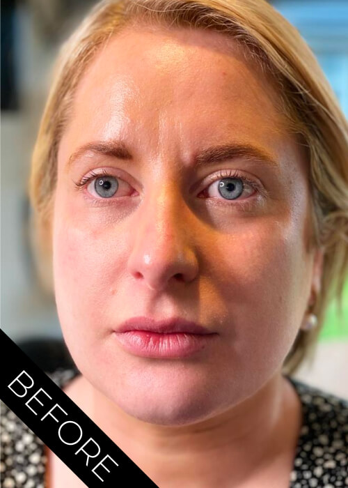 Face Contour before