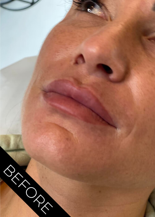 Before Lips Fillers Ballyclare