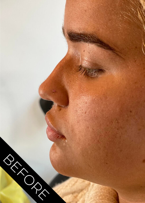 Before facial contouring treatment