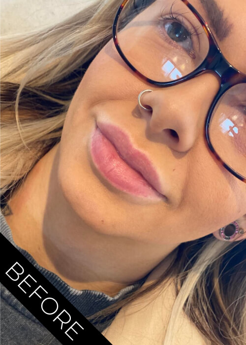 Before Lip Filler