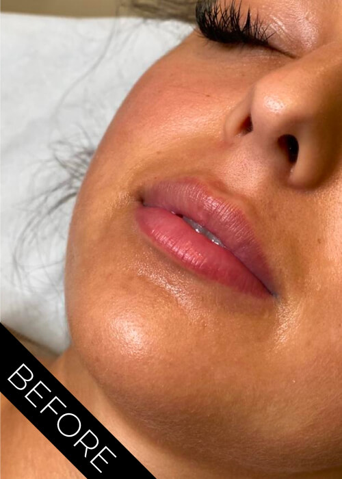 Before 1.1ml Lip Filler
