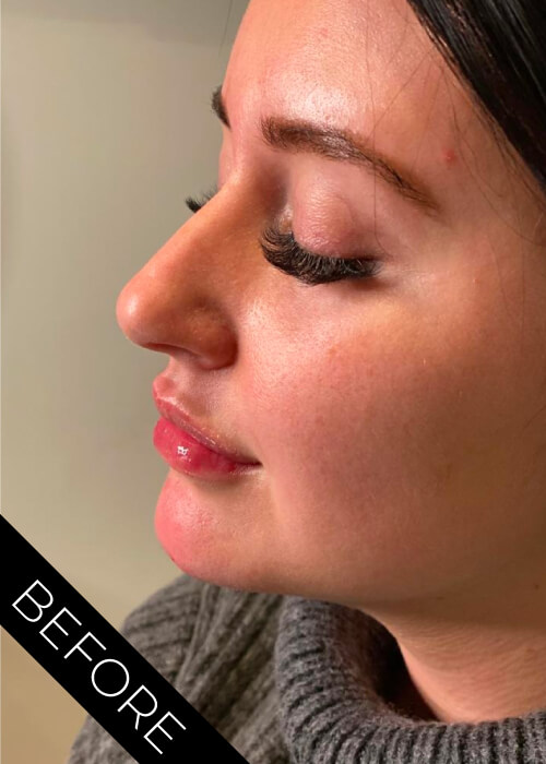 Lip filler before in Northern Ireland