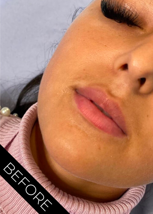 Lip filler before